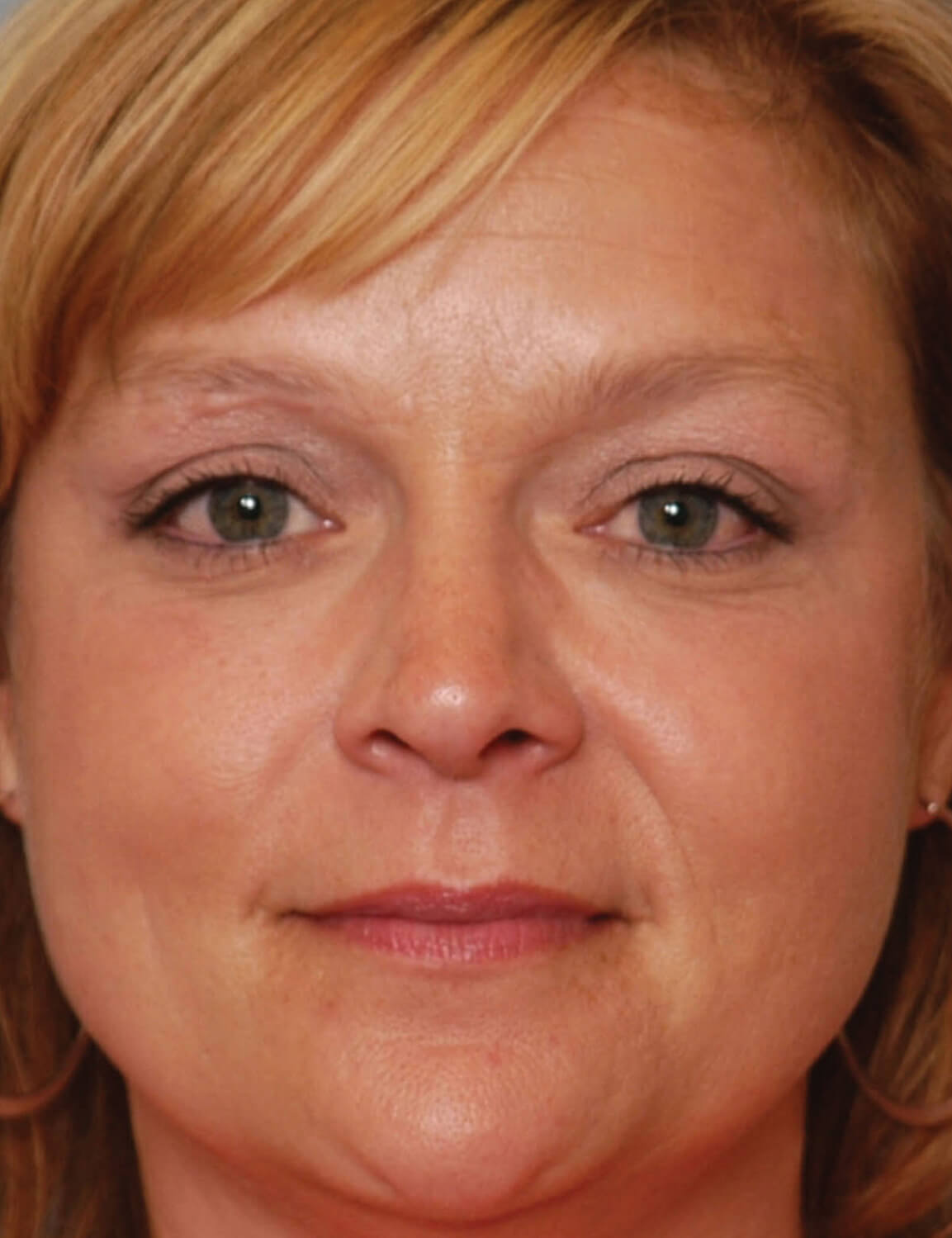 IPL Photofacial Dublin IPL Pleasanton