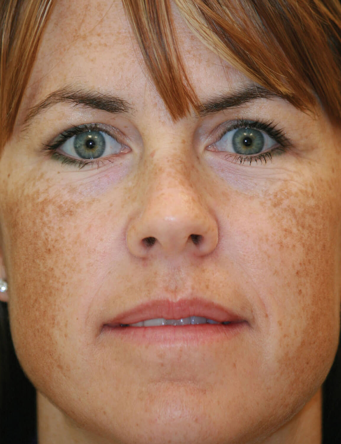 IPL Photofacial Dublin IPL Pleasanton
