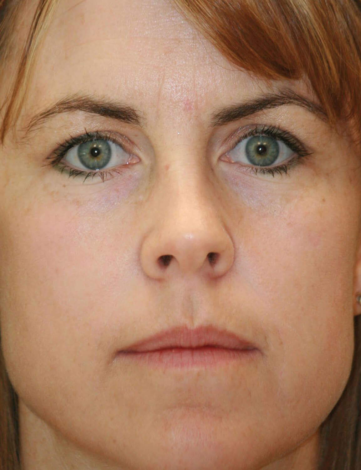 IPL Photofacial Dublin IPL Pleasanton