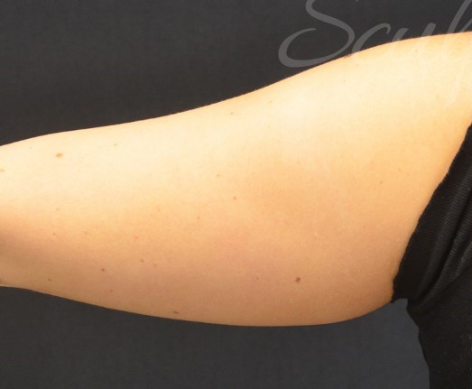 Coolsculpting back of arms best sale