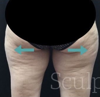 CoolSculpting Outer Thighs Before and After Photos Sculpt MD Medspa