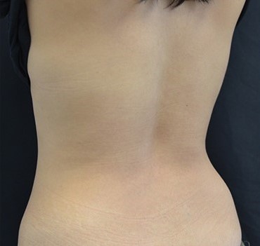 Backtics Shape Back - Sculpt MD
