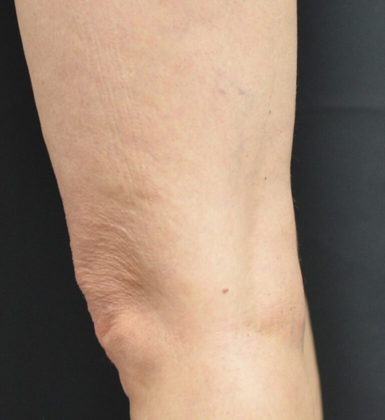 Skin Tightening Before and After 01 Sculpt MD Medspa