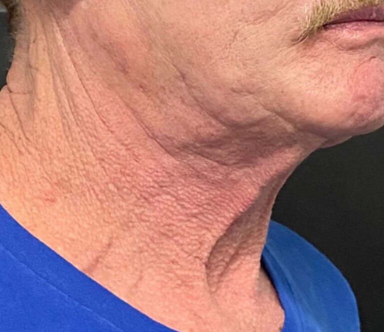 Morpheus8 Before and After Photos Sculpt MD Medspa