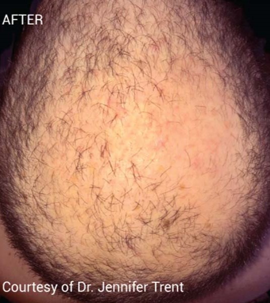 PRF Hair Restoration Before and After Image Gallery - Sculpt MD