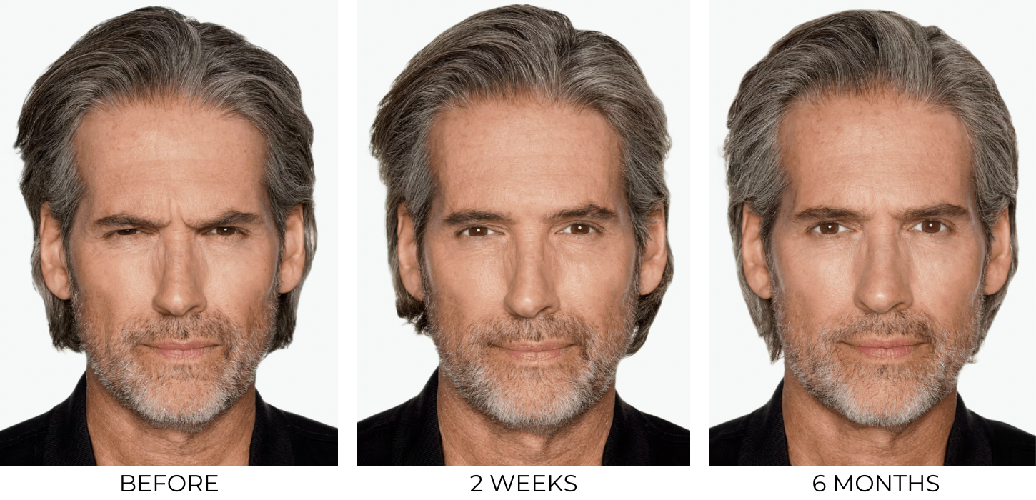 Daxxify before and after results for a middle-aged man.