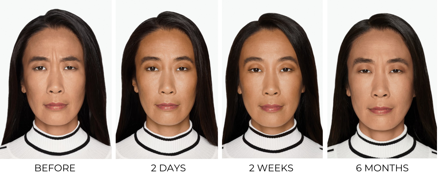 Before and after images showing Daxxify results for a middle-aged woman